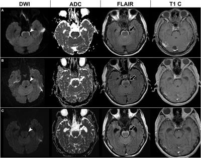 Novel Anterior Brainstem Magnetic Resonance Imaging Findings in Non-Small Cell Lung Cancer with Leptomeningeal Carcinomatosis